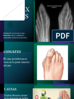 Hallux Valgus