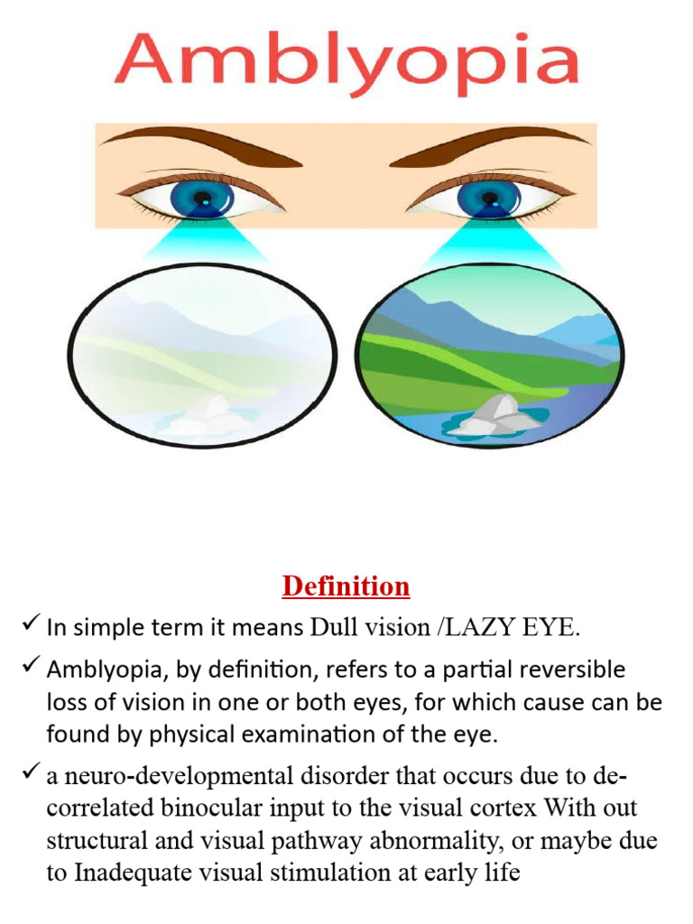 Amblyopia: Definition and Management | PDF | Visual Acuity | Vision