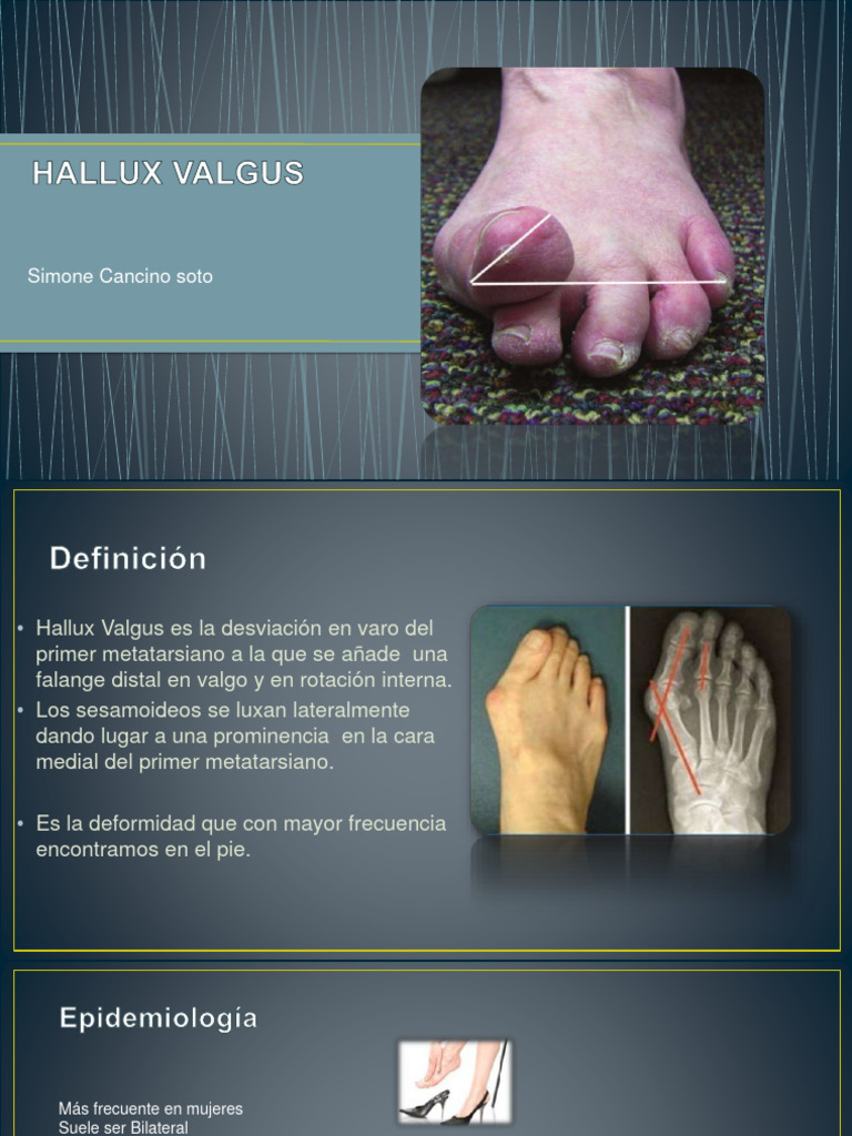 Halluxvalgusdiapositiva 151019173709 Lva1 App6892 | PDF