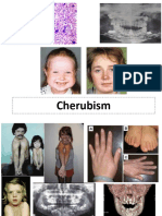 Cherubism