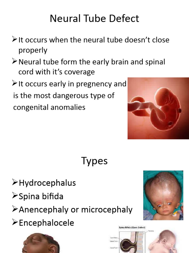 Neural Tube Defect PDF Cerebrospinal Fluid Neurology
