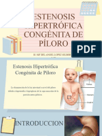 Hipertrofia de Piloro