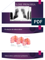 Tuberculose Primária. 01