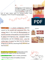 Dental Plaque and Dental Caries