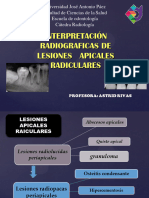 CARACTERÍSTICAS RADIOGRÁFICAS DE LAS LESIONES PERIAPICALES 2020