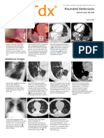 Rounded Atelectasis - Print Friendly - STATdx