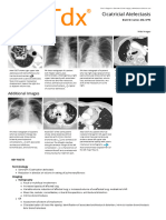 Cicatricial Atelectasis - Print Friendly - STATdx