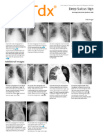 Deep Sulcus Sign - Print Friendly - STATdx