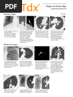 Finger-in-Glove Sign - Print Friendly - STATdx