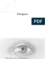 Pterigium