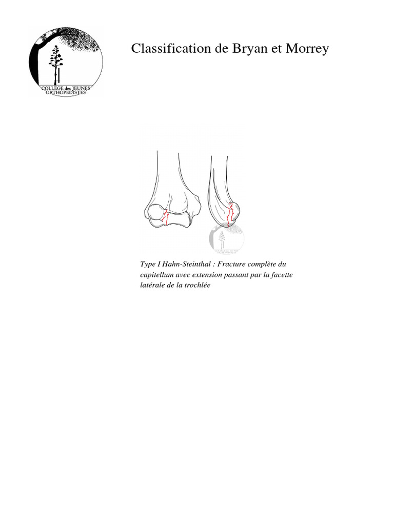 Classification des fractures du capitellum | PDF | Politique