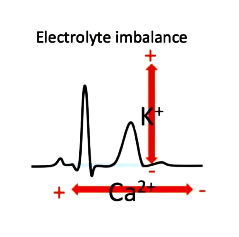 How To Measure Calcium Levels by Looking ECG PDF