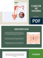 Cancer de Vagina