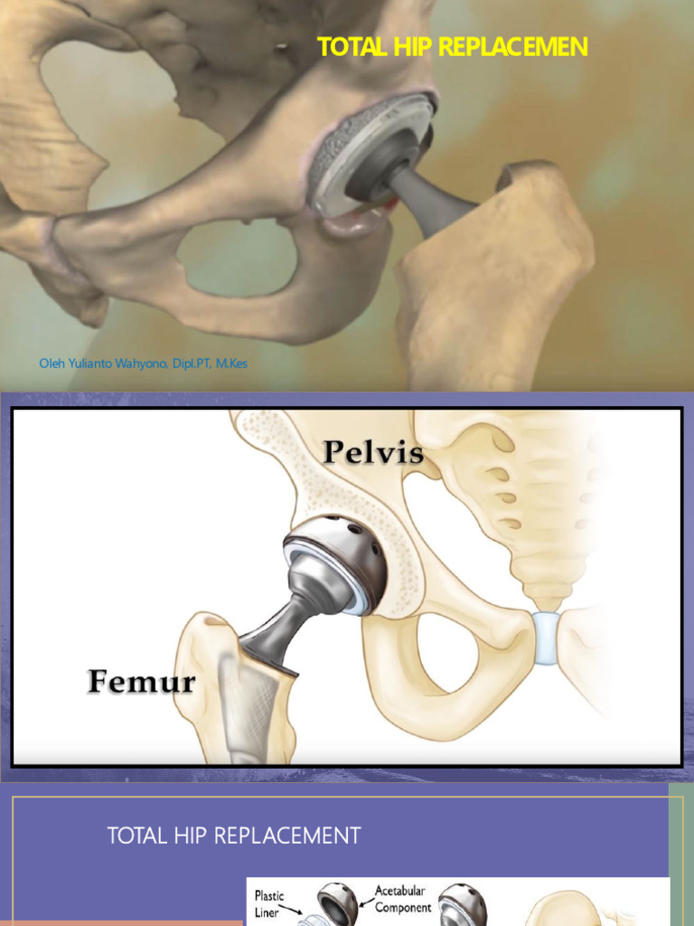 Total Hip Replacement PDF