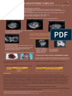 Mola Hidatiforma Completa