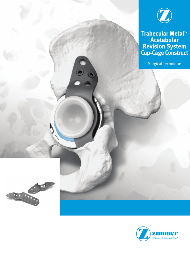 Zimmer Trabecular Metal Acetabular Revision System Cup Cage Construct 2