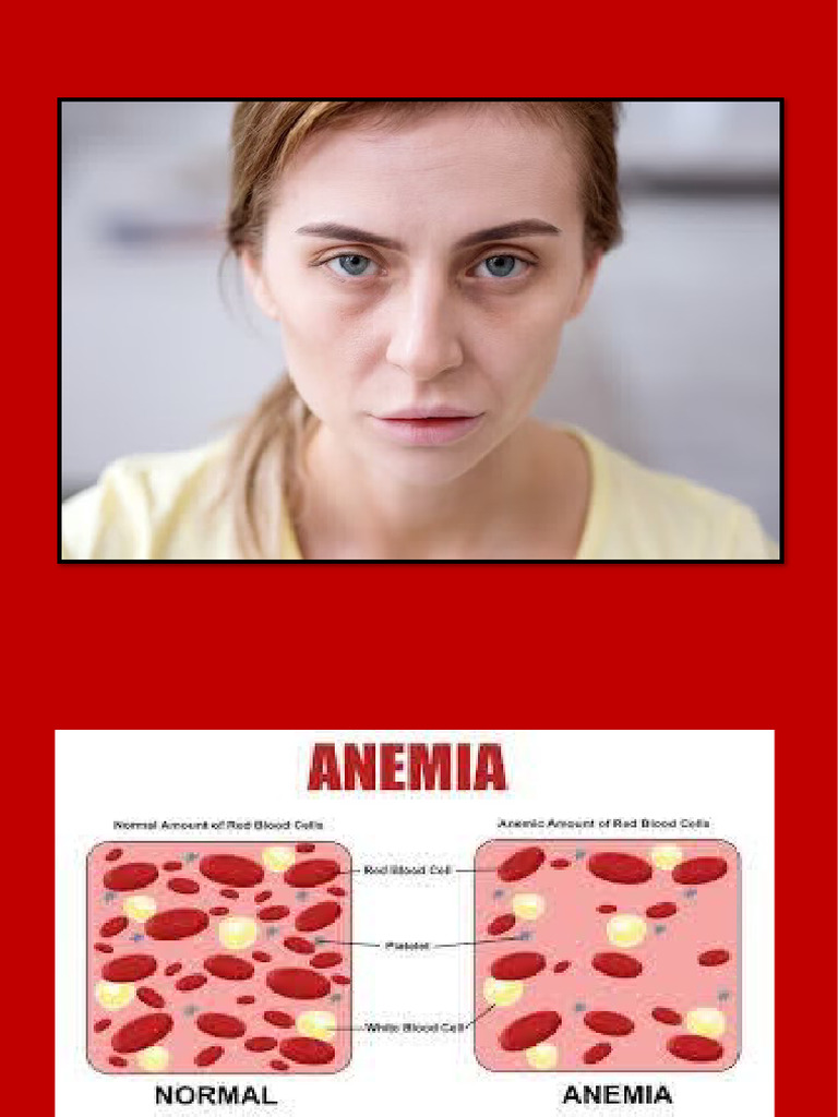 ANEMIA PDF