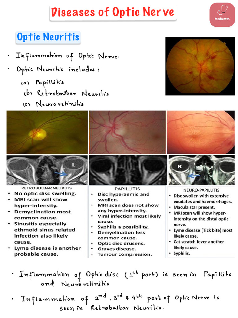 Diseases of Optic Nerve | PDF
