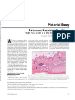 Silva Et Al 2012 Asthma and Associated Conditions High Resolution CT and Pathologic Findings