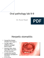 Oral Pathology Herpetic Stomatitis