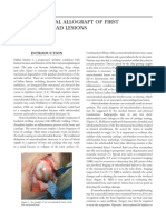 Osteochondral Allograft of First Metatarsal Head Lesions: Robert M. Goecker, DPM