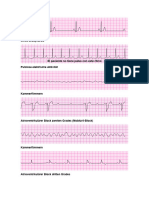 Acls Ekg