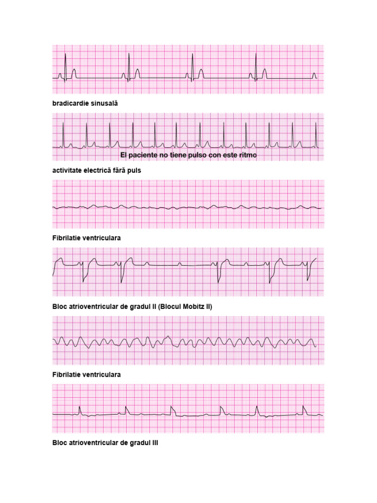 Acls Ecg | PDF