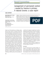 Dental Traumatology - 2009 - T Z Ner - Temporary Management of Permanent Central Incisors Loss Caused by Trauma