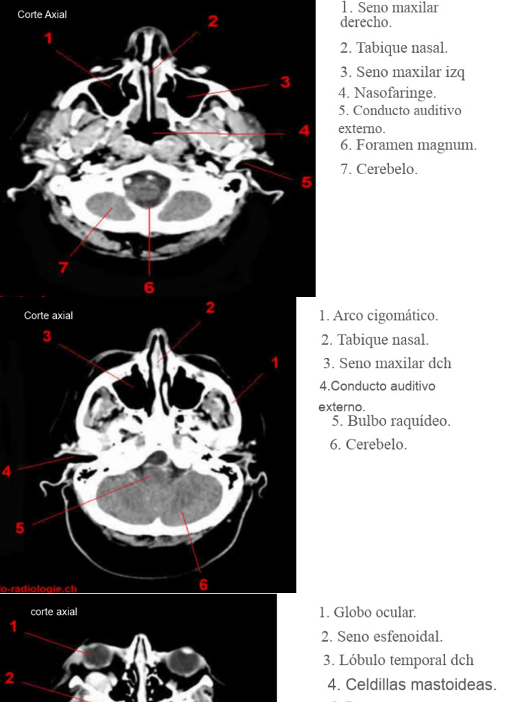 Craneo Tc Pdf Anatomía Humana Cabeza Y Cuello Humanos