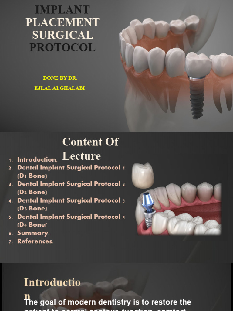 SURGICAL GUIDE FOR IMPLANT PLACEMENT PPT intelligence overview