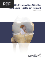 Acl Tightrope Attachable Button System | PDF | Musculoskeletal System ...