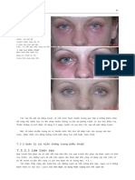 State of The Art in Blepharoplasty From Surgery To The Avoidance of Complications-5