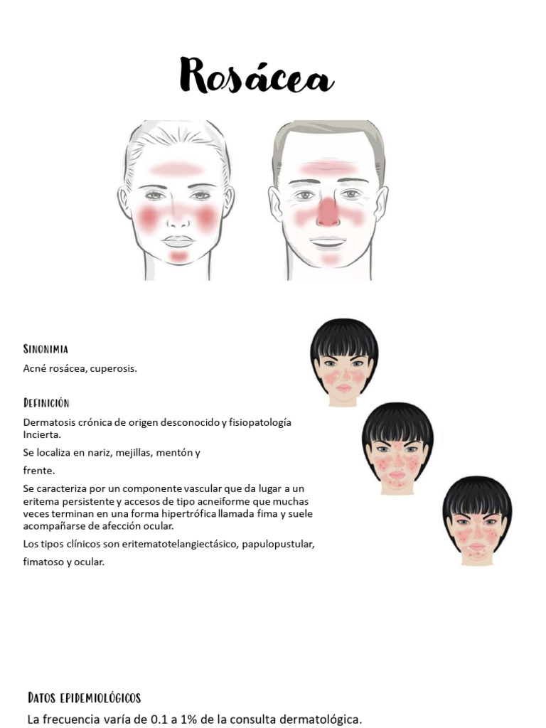 Lymecycline Rosacea Cks