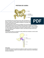 Protesis de Cadera Nuevo