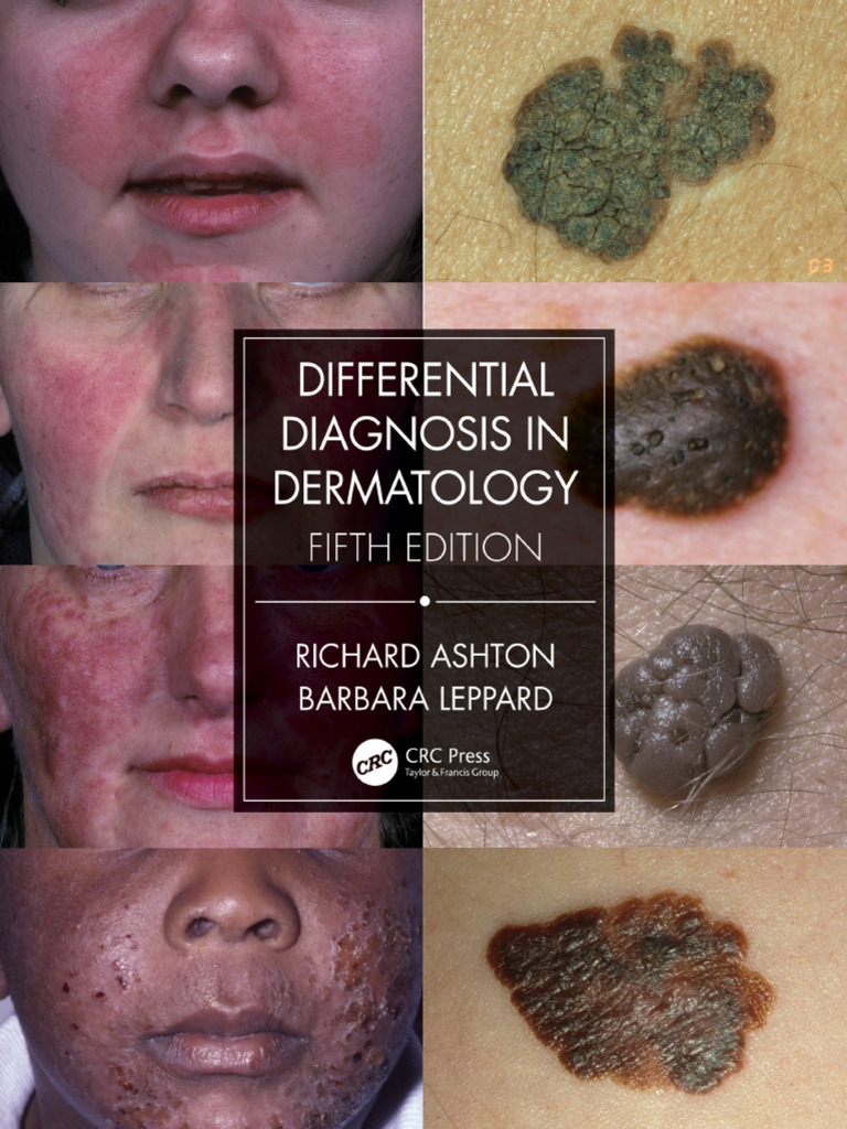 Differential Diagnosis in Dermatology (Ashton) 5 Ed (2021) PDF