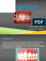 Gingivitis 160730200344