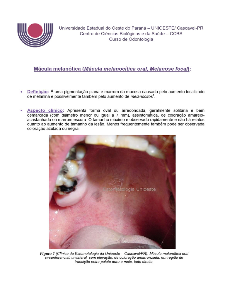 macula melanotica oral melanoacantoma oral vrs macula melanotica oral | Marjorie Marcela main image 0