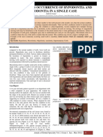 Simultaneous Occurrence of Hypodontia and Microdontia in A Single Case