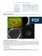 Multimodal Imaging of A Pigmented Vitreous Cyst - Op