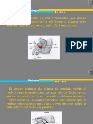 Diagnózis és terápia - Cancer de prostata diagnostico pdf