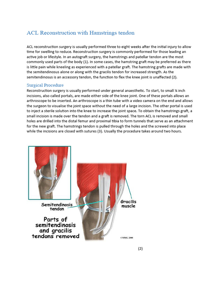 ACL Reconstruction with Hamstrings tendon PDF