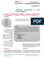 Non-Hodgkin's Malignant Lymphomas of The Palatine Tonsils: A Case Report