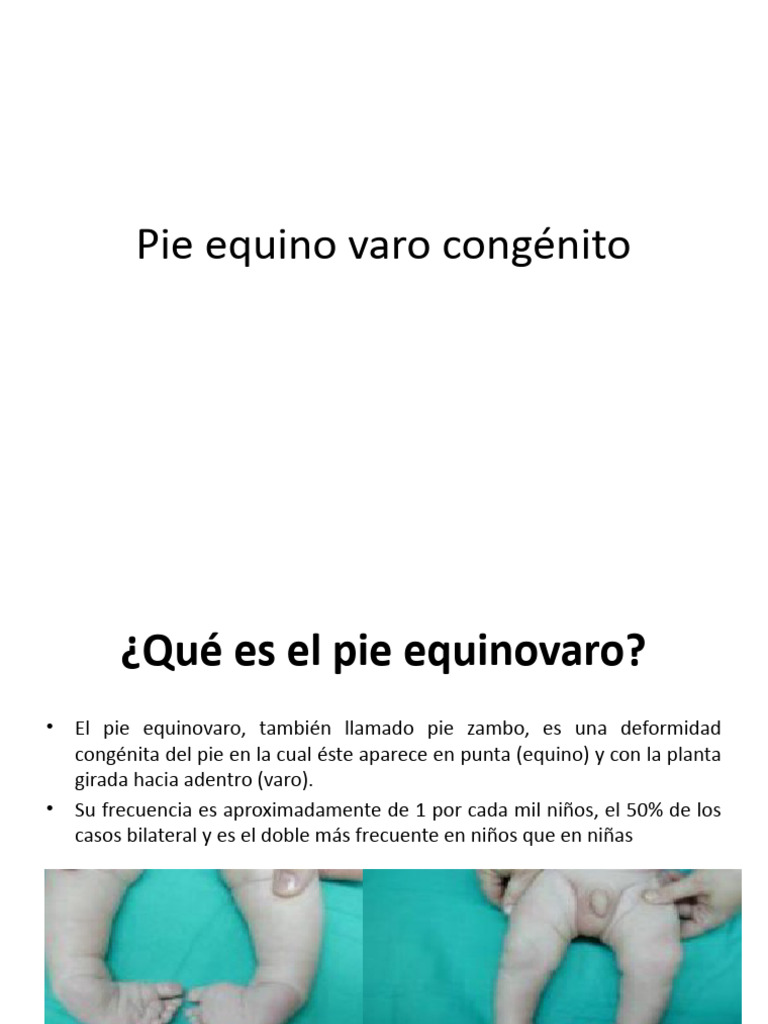Pie equino varo congénito PDF Pie Especialidades Medicas