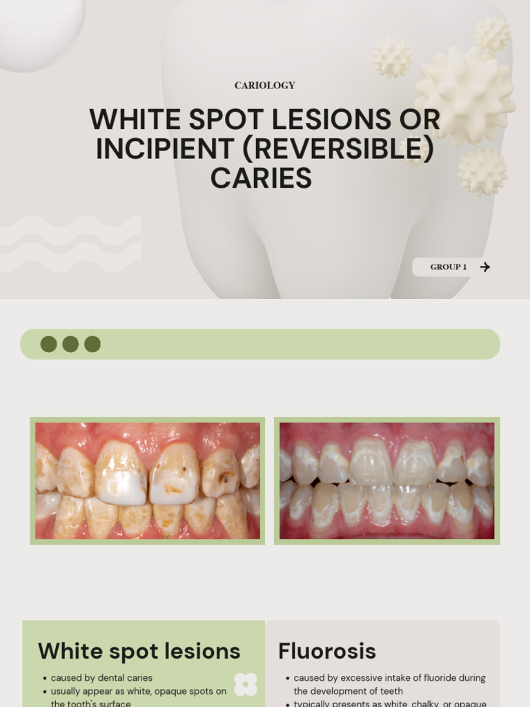 White Spot Lesions - Group1 | PDF | Tooth Enamel | Orthodontics