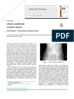 Litiasis Coraliforme