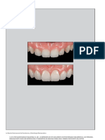 The Influence of Tooth Color On Preparation Design For Laminate Veneers From A Minimally Invasive Perspective (1) .En - Es