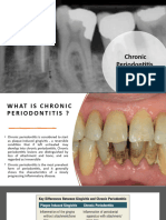 Chronic Periodontitis