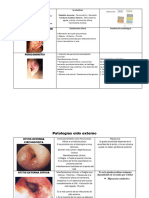 Otitis Externa