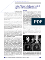 Treating Triple Thrombus Pulmonary, Cardiac, and Cerebral: A Case Management With Calculated Conscience