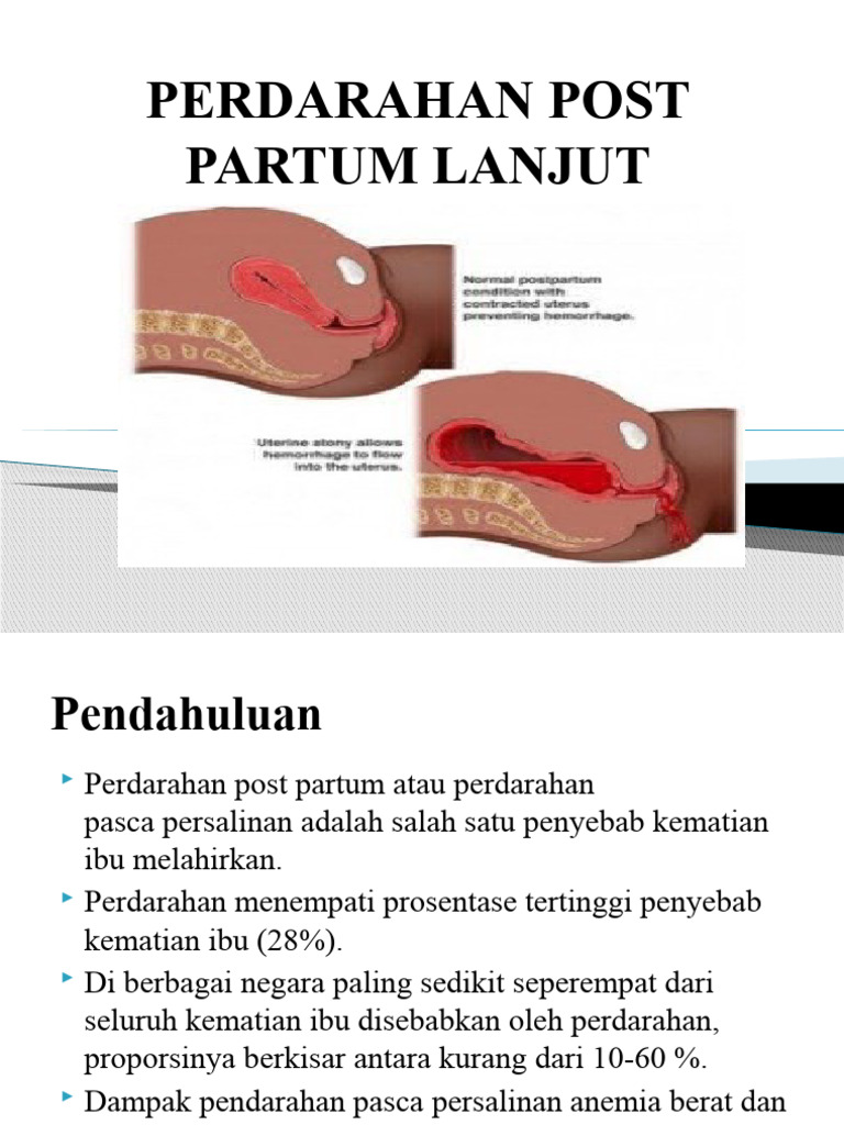 Perdarahan Post Partum Lanjut | PDF